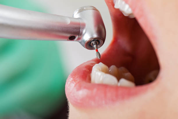 Best Emergency Root Canal Treatment in Walker Mill, MD